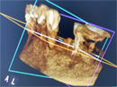 CTによる長持ちするインプラント