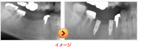 インプラント・院長治療例紹介