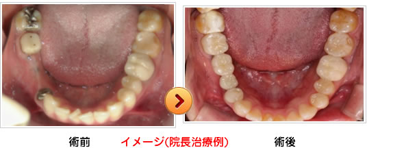 インプラント・院長治療例紹介