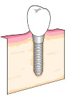 インプラント