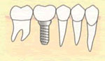 インプラント