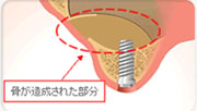 サイナスリフト