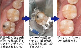 ダイレクトボンディング症例