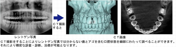 歯科用CT