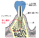 インプラント