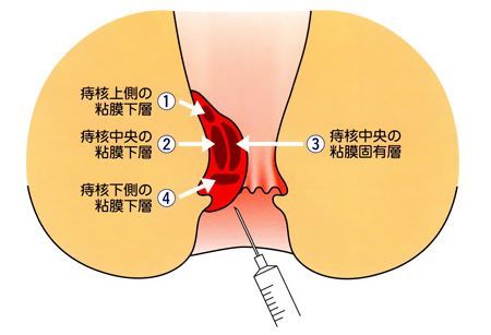 痔の治療